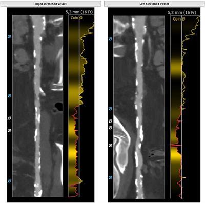 Challenging Anatomies for TAVR—Bicuspid and Beyond